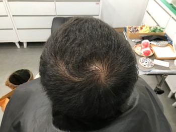 두피문신 시술 전 마른상태2