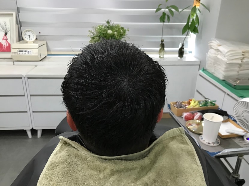 두피문신 시술 후 젖은상태