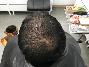 두피문신 시술 전 젖은상태2