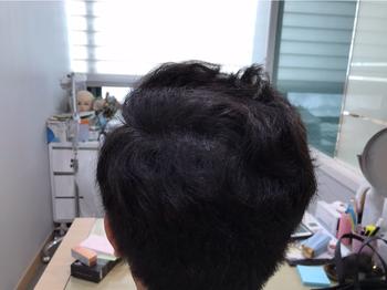 두피문신 2년 후 상태