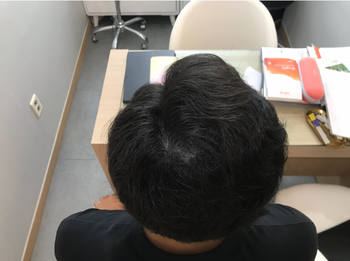 두피문신 5년 후 현재상태