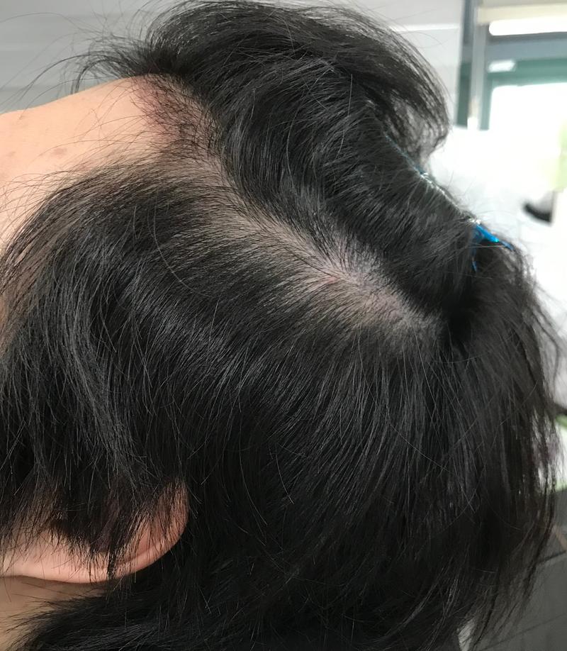 옆머리 두피문신 후기