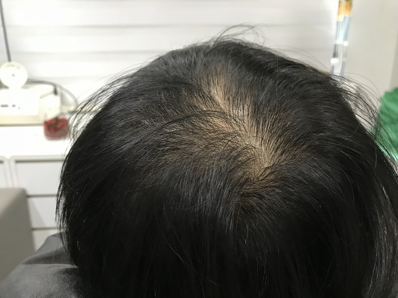 我生平第一次头皮纹身后记.. 结果非常满意