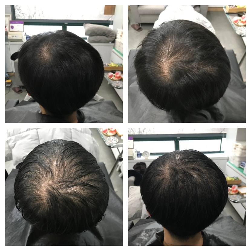 시술 전 제 머리입니다 많이 심각했죠??? (이러고 어떻게 생활했는지 참,,)