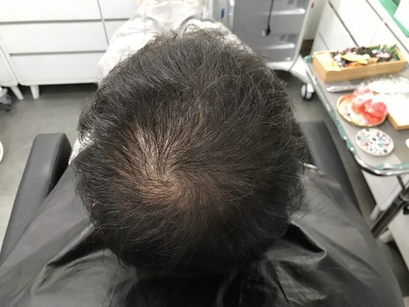 [延世美达人] 收到了渐变头皮的纹身