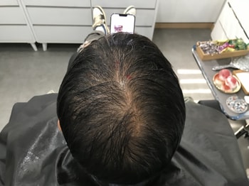 시술전