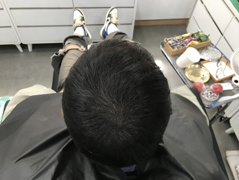 시술후