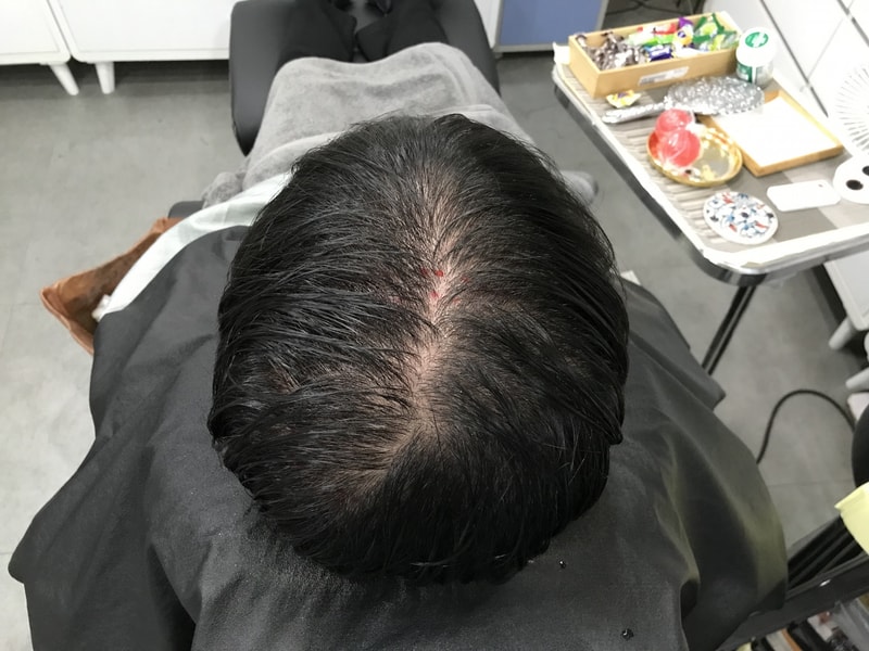 樹脂針微細ドット後記