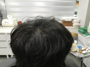시술 후 마른머리2