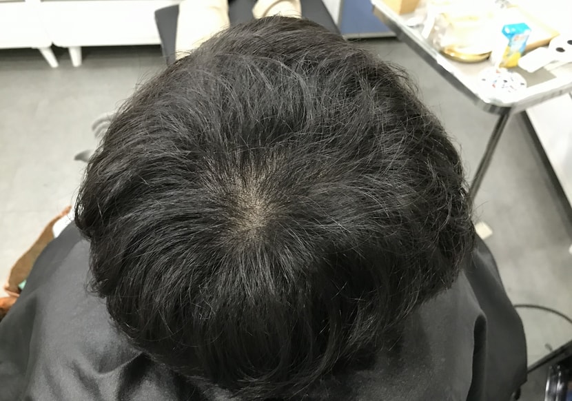 시술 후 마른머리