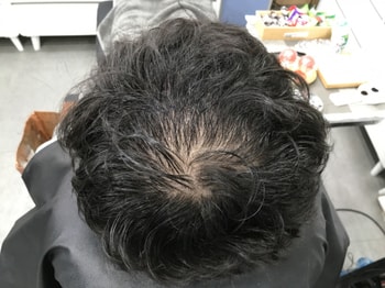 시술 전 젖은머리