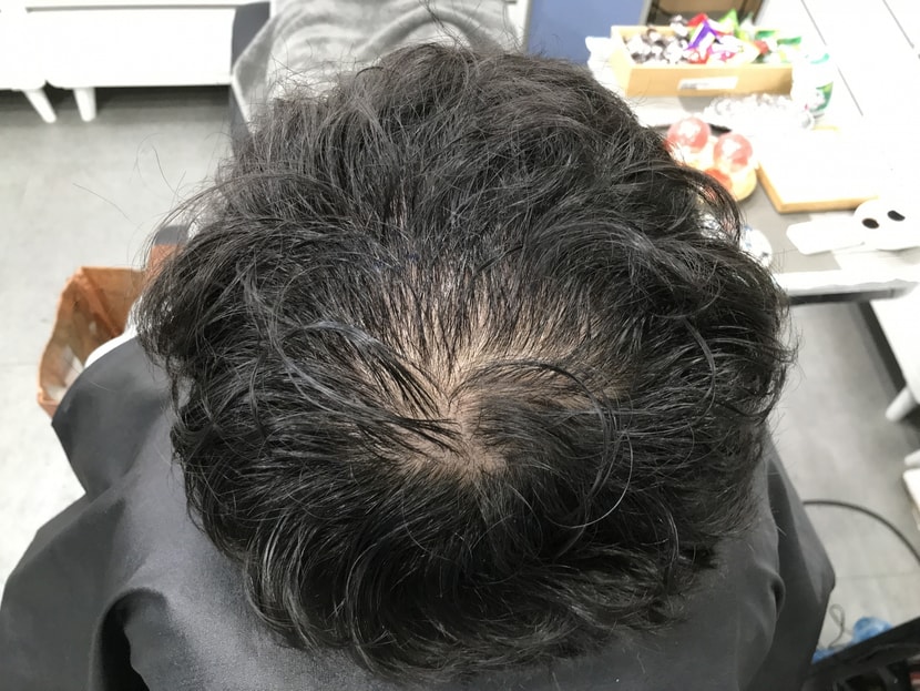 시술 전 젖은머리