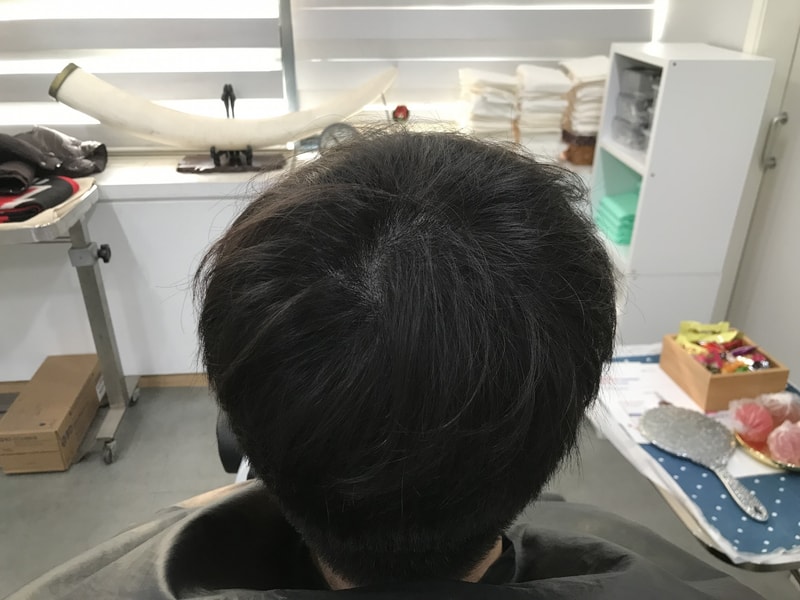 头皮纹身修复后记