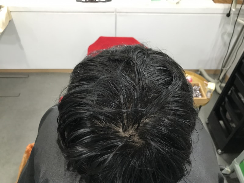 头皮纹身 树脂微针+机器圆点 [延世美达人] 后记