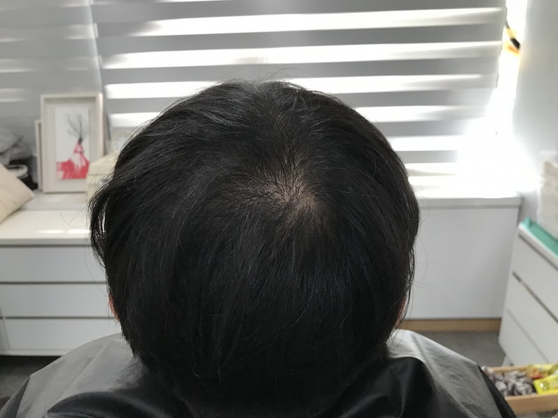 頭皮タトゥー後記