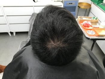 이게 시술전 사진입니다.