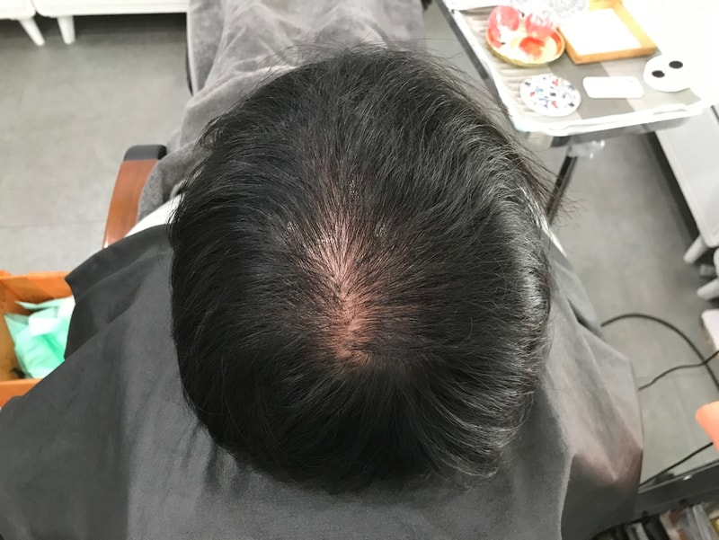 [ヨンセミダイン]頭皮タトゥーのレビューです~ +気になることコメントで言ってくださいヨン