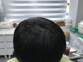 시술 후 