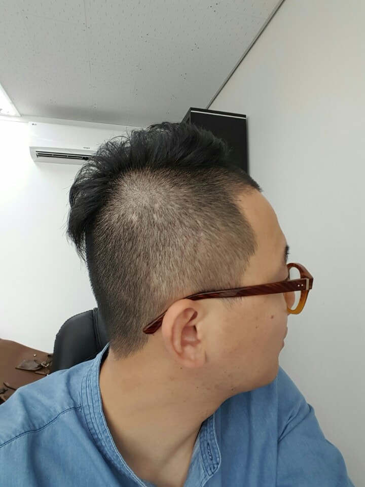 시술받고 이발후_옆흉터