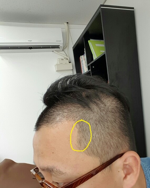 시술받고 이발후_라인흉터