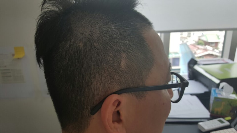 옆흉터1