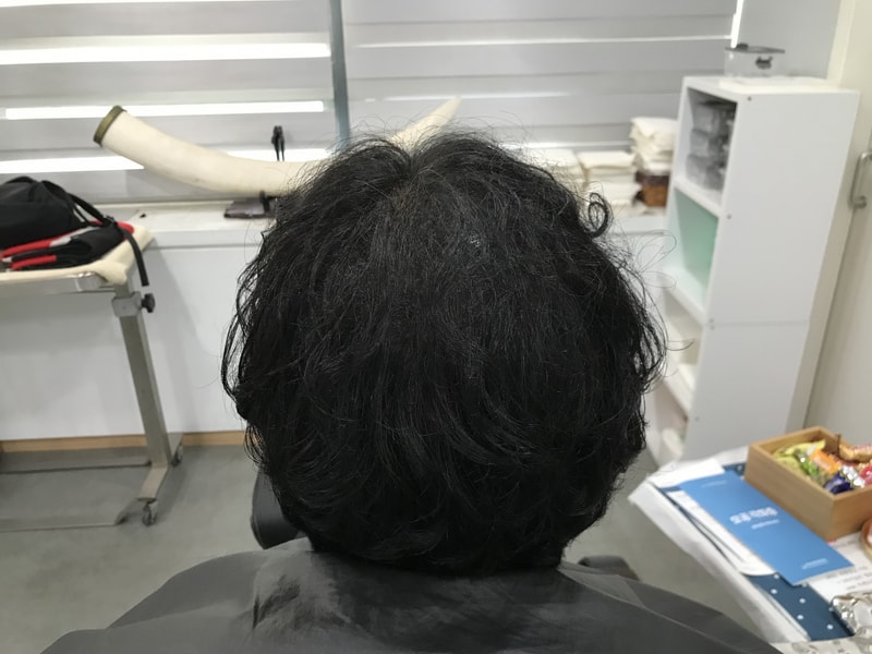 頭皮タトゥーリタッチ後のリタッチ