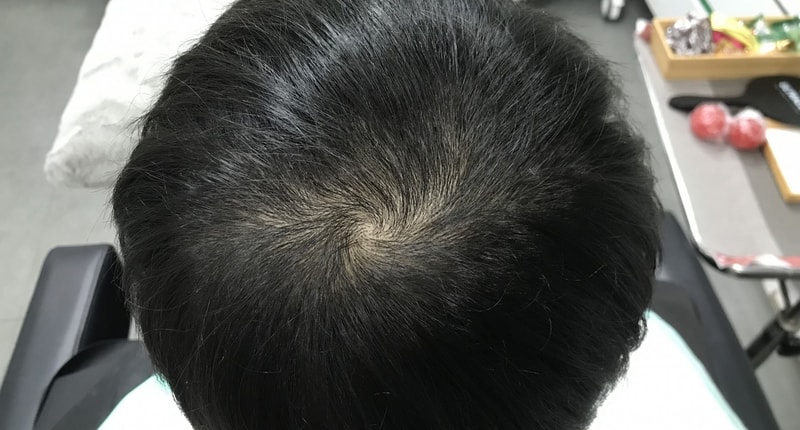 延世美达人头皮纹身后记