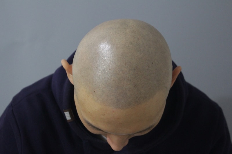 这张是光头皮纹身1年后的照片~~