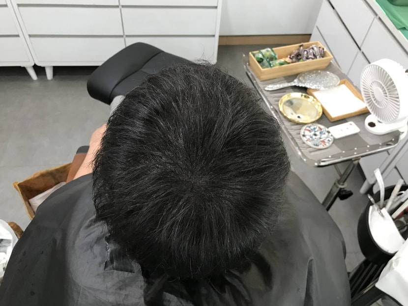 시술 후 말린 머리
