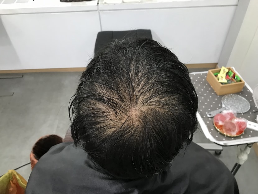 시술 전 젖은 머리