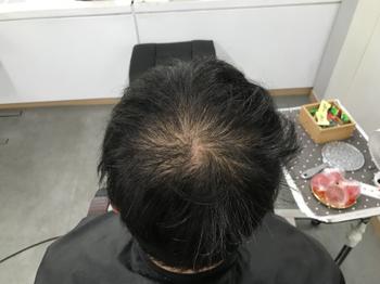 시술 전