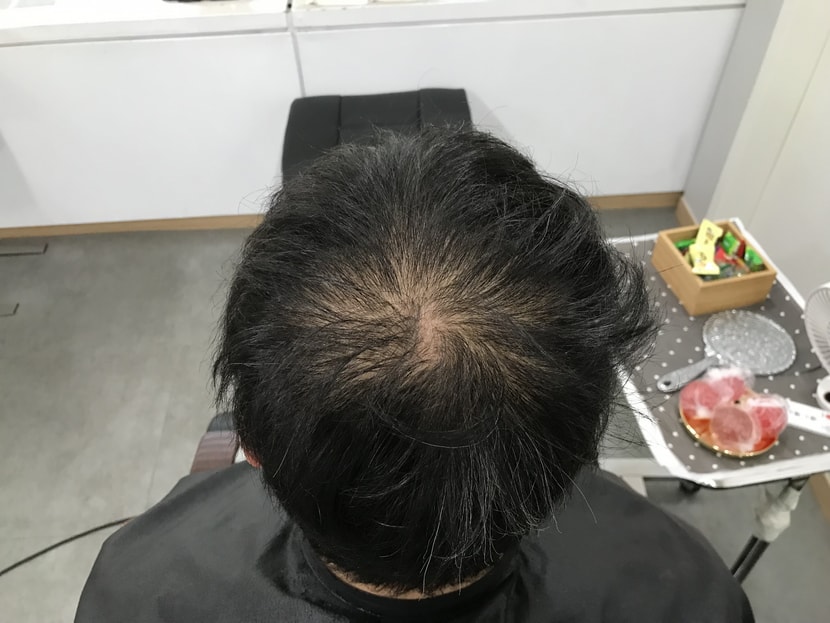 시술 전