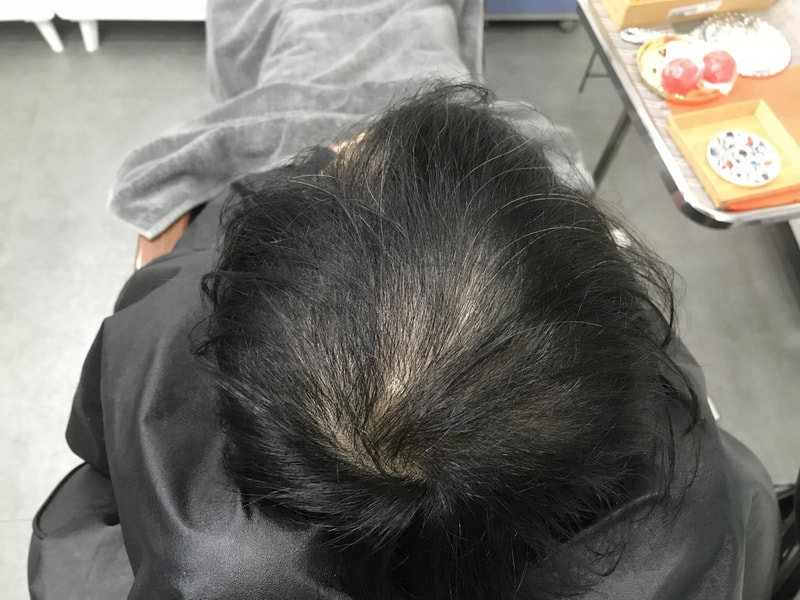 두피문신 1차 받고왔습니다!!