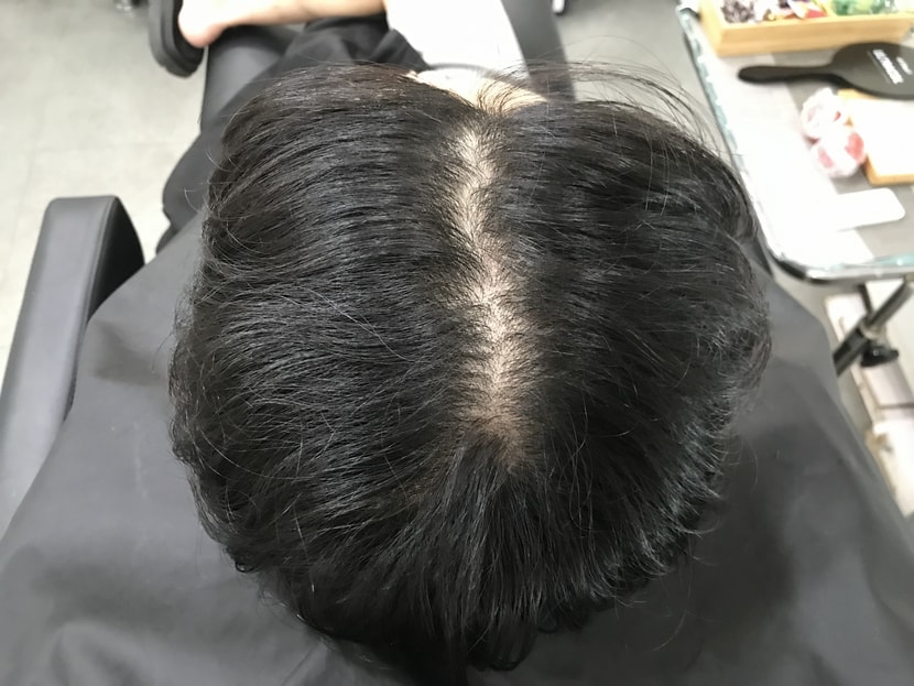 시술전1