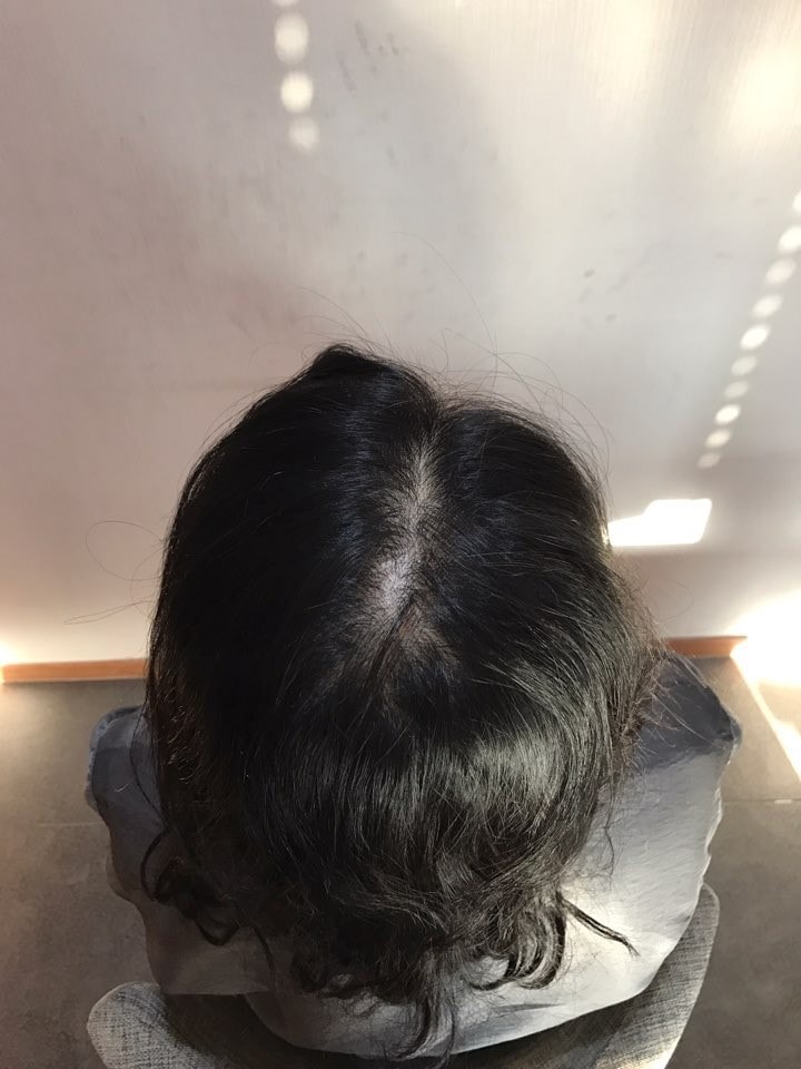 시술 전 찍어준 사진