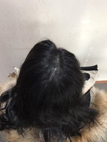 시술 후 찍어준 사진