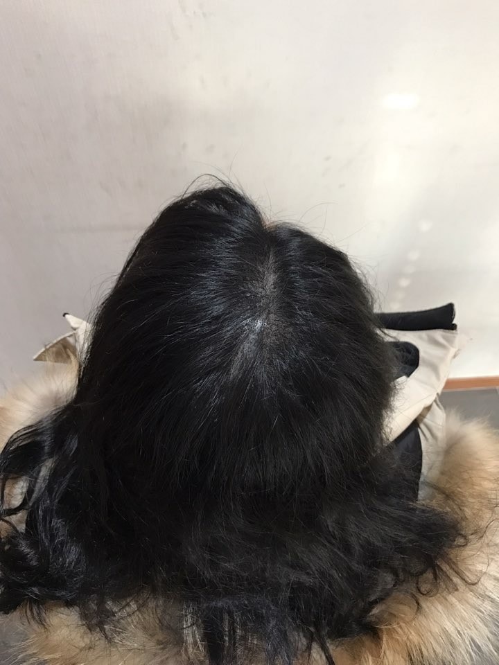 시술 후 찍어준 사진
