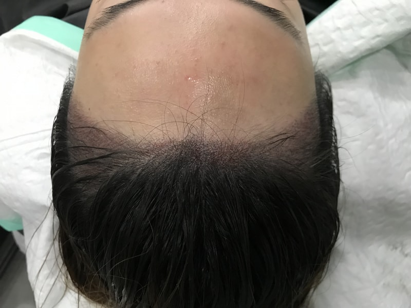 延世美达人头皮纹身及碎发再生术后记