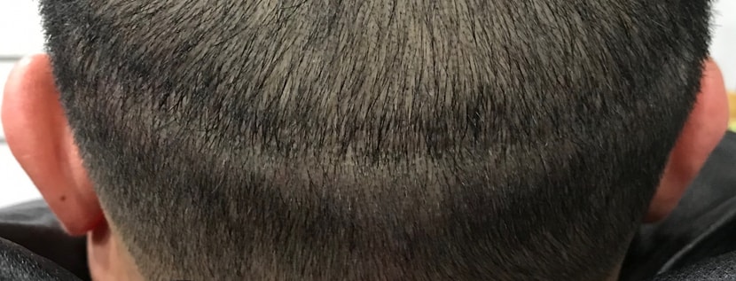 상처부위 시술후