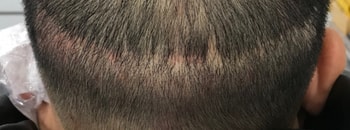 상처부위 시술전