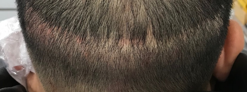 상처부위 시술전