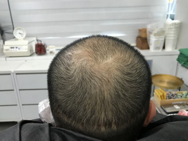 经过长时间的考虑 终于做了头皮纹身手术