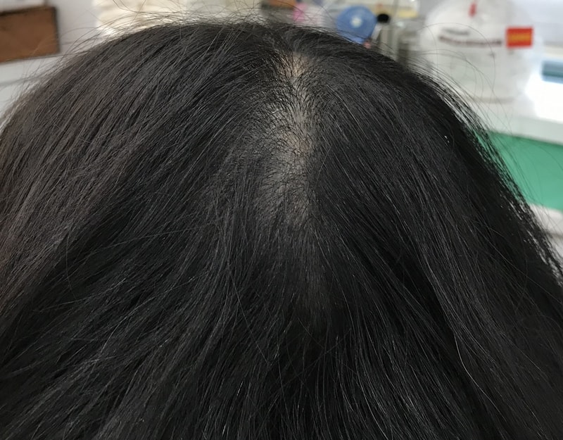 頭皮タトゥー後記