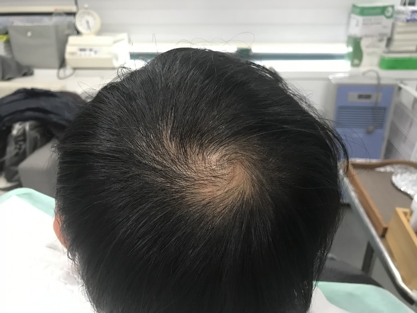 시술 전-물 묻기 전