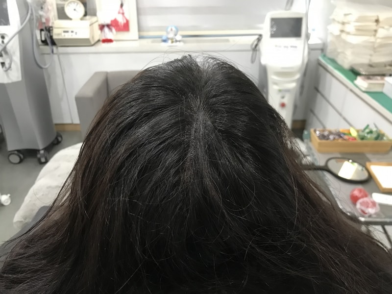 Yonsei Midain Clinic头皮纹身后期