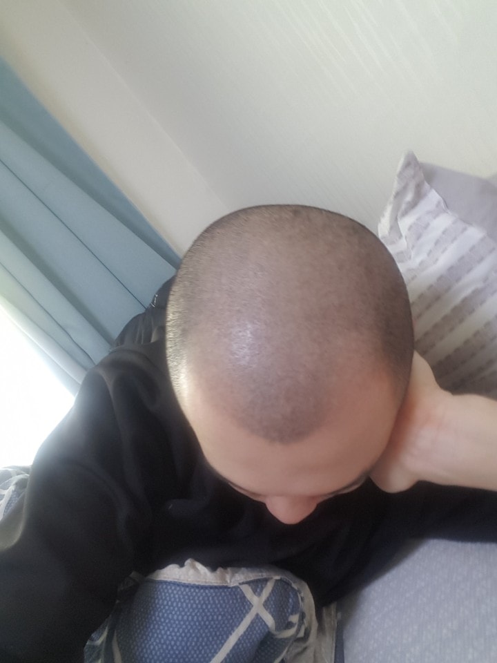 江南xx整容外科的头皮纹身后记...