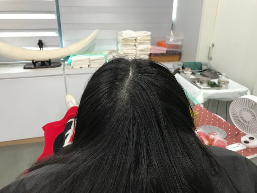 2차 레이저 시술 후(보강 후)
