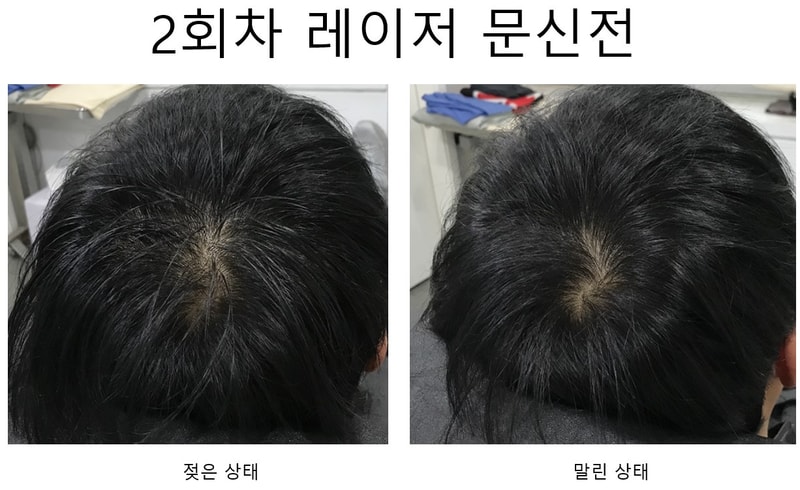 [头皮纹身] 是激光第二次后期