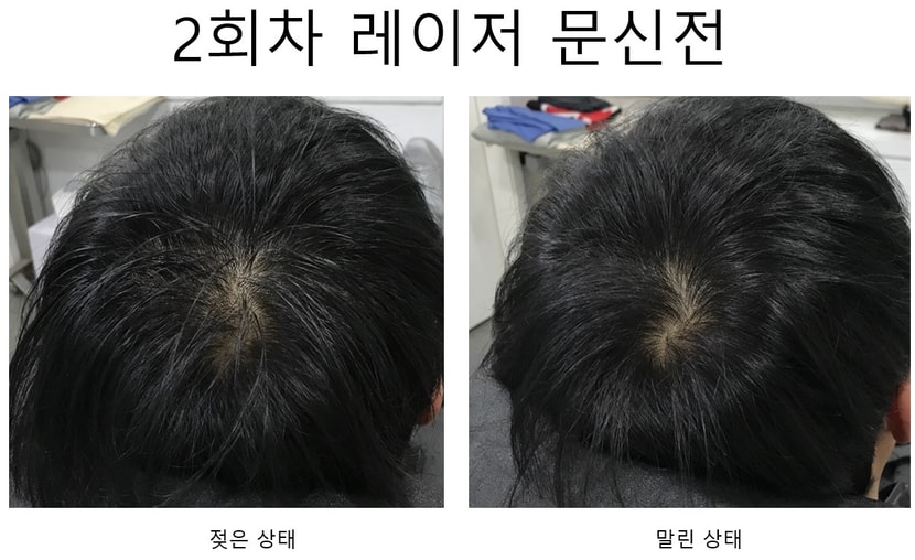 2회차 레이저 문신전