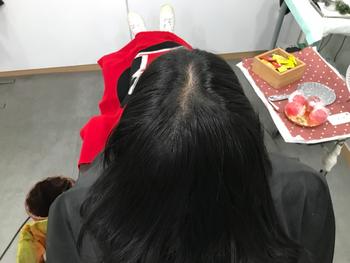 1차 레이저 시술 후 14일 뒤(보강 전)